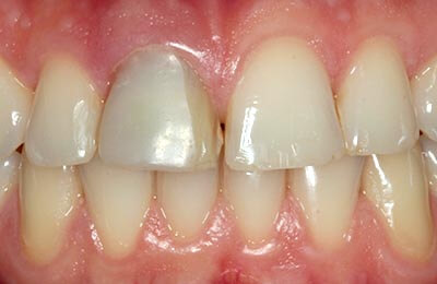 Praxis Dr. Zwanzig: Verfärbter Zahn 11 mit unansehnlicher Kunststofffüllung