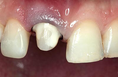 Praxis Dr. Zwanzig: Zahnstumpf nach internem Bleichen und adhäsivem Aufbau