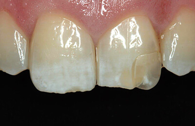 Ästhetische Korrekturen: Unbefriedigende Ästhetik Zahn 21 durch schlecht sitzendes Veneer