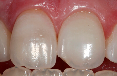 Bielefeld Implantate: Die ursprüngliche Zahnfarbe konnte wieder erreicht werden