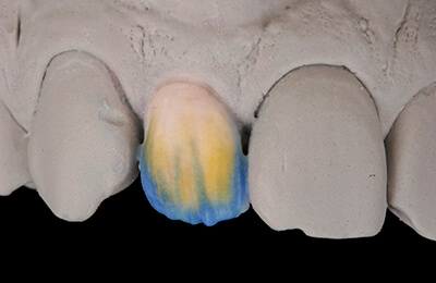 Bielefeld Implantate: Individuelle Keramikschichtung der Implantatkrone