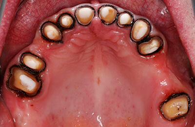 Komplexe Fälle: Zähne im Oberkiefer nach konservierender Behandlung