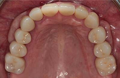 Komplexe Fälle: Kronen nach der Verklebung im Mund