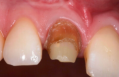Zahnfleischchirurgie Bielefeld: Kariöser Zahnstumpf unter der alten Krone
