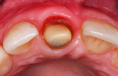 Zahnfleischchirurgie Bielefeld: Zustand nach Gewebeverdickung