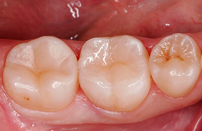 Zahnarztpraxis Bielefeld: Fertig ausgearbeitet und polierte Füllung