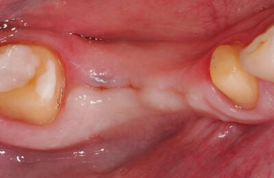 Implantate Bielefeld: Ausgangsbefund der fehlenden Zähne 45 und 46