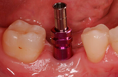 Implantologie Bielefeld: Nach Zahnfleischkorrektur und Freilegung die Abformung
