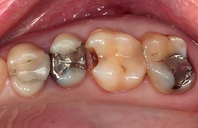 Zahnarztpraxis Bielefeld: Unansehliche Füllungen mit kariöser Zahnsubstanz