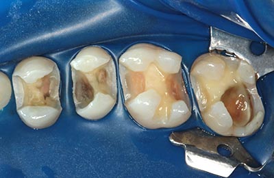 Zahnarztpraxis Bielefeld: Zähne unter Kofferdam nach Entfernung der Karies