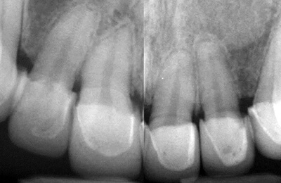 Zahnprothetik Bielefeld: Radiologisch erkennt man die nicht passenden Kronen