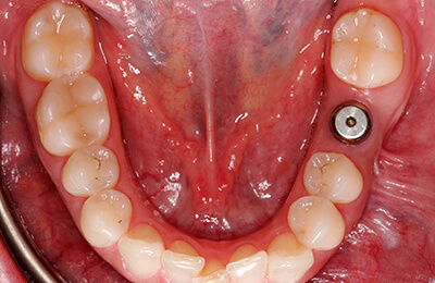 Implantologie Bielefeld: Eingesetztes Implantat an Position 36 mit Zahnfleischformer