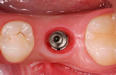 Implantat: Innenleben des Implantats mit reizfreiem Zahnfleisch