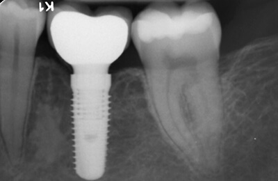 Implantologie: Das Röntgenbild zeigt den spaltfreien Sitz der Krone