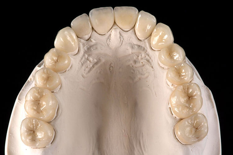 Zahnarzt die perfekten Kronen