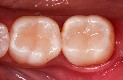 Zahnarztpraxis Bielefeld: Neuversorgung der Zähne 37 und 36 mit hochästhetischen Füllungen