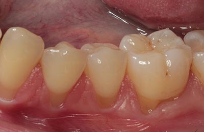 Zahnfleischchirurgie Bielefeld: Freiliegende Wurzeloberflächen durch starken Zahnfleischrückgang