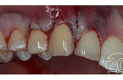 Zahnfleischchirurgie Bielefeld