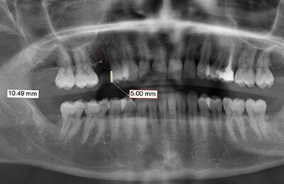 Zahnimplantat: Digitale Längenmessung fehlender Zahn 15