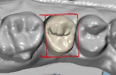 Zahnimplantat: Computergenerierte Krone auf Implantat 15