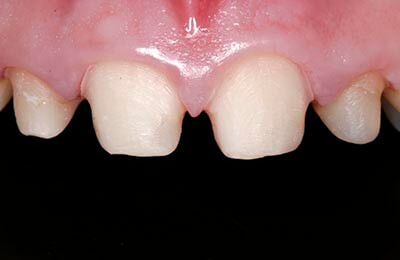 Zahnprothetik Bielefeld: Aufgebaute und präparierte Zähne