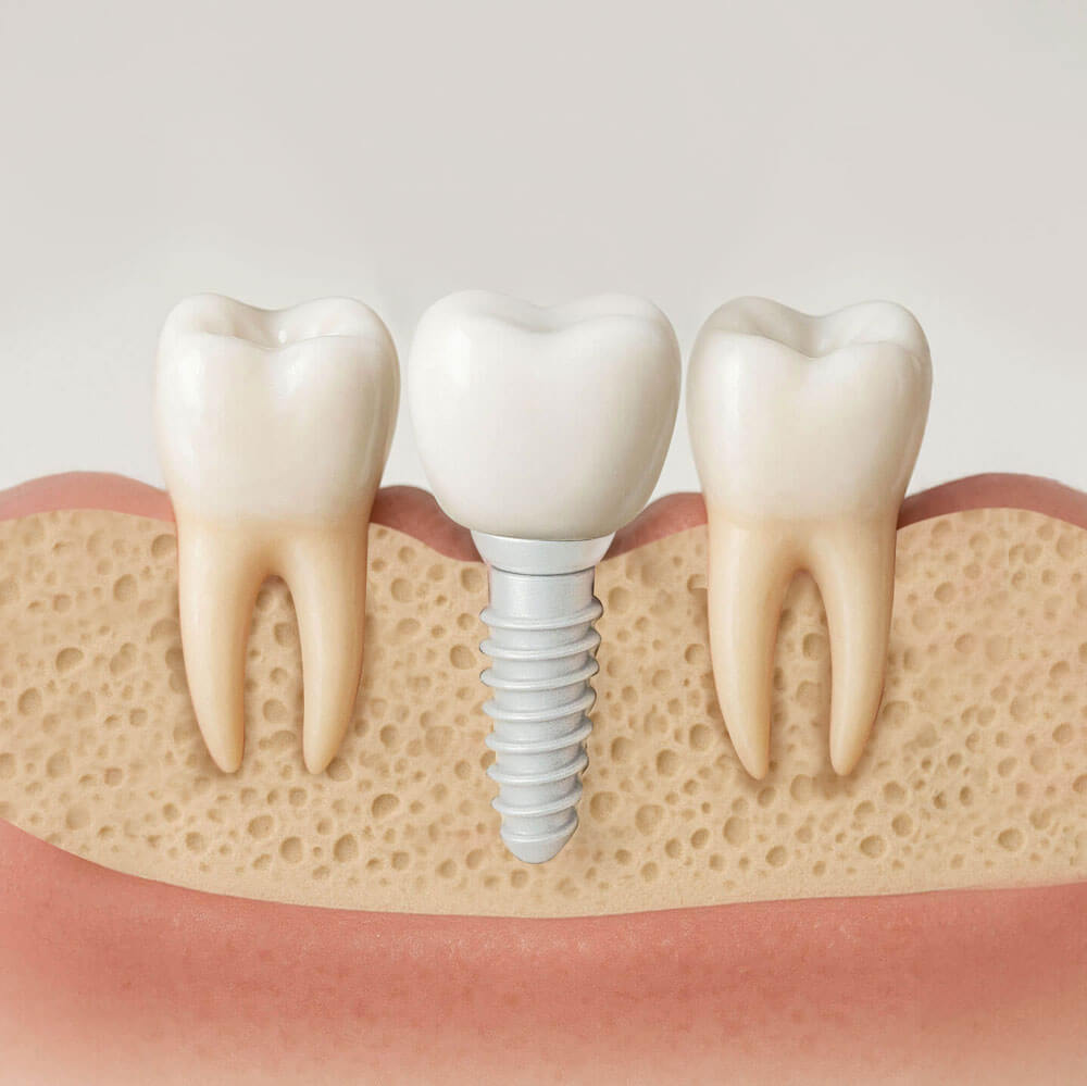 Titanimplantat von Zahnarzt Dr. Zwanzig in Bielefeld
